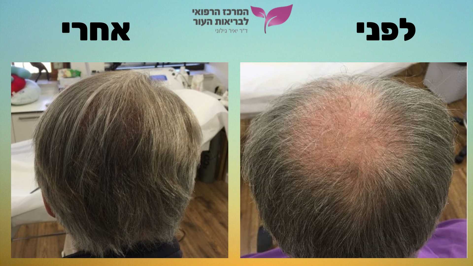 לפני אחרי ד"ר גילוני