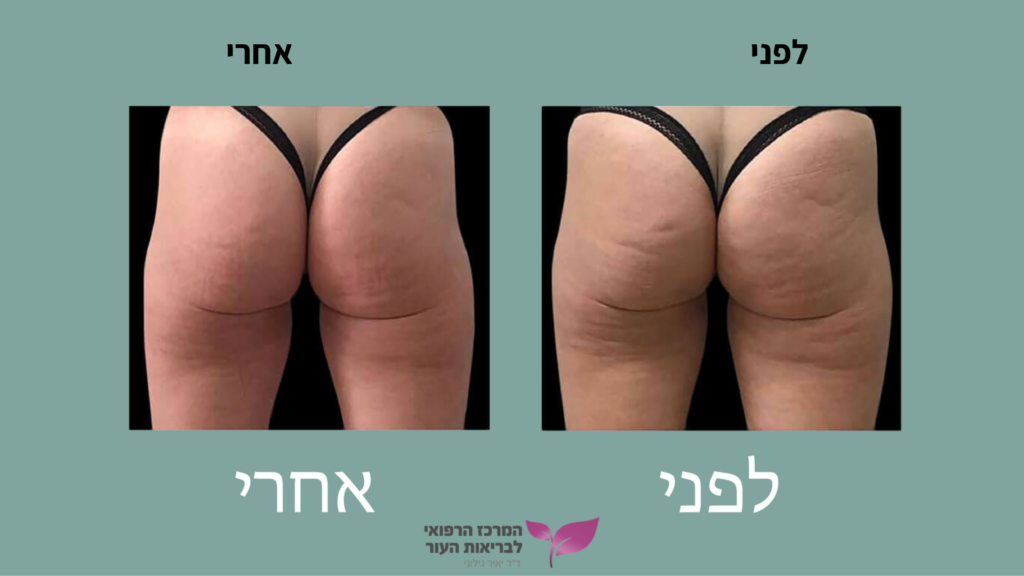 טיפול בצלוליט - לפני אחרי
