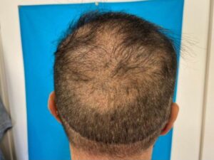 השתלת שיער סינתטי - לפני טיפול