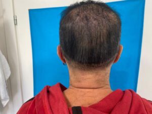 השתלת שיער סינתטי - אחרי טיפול 2