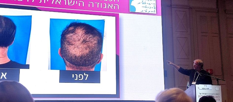 ד"ר יאיר גילוני מציג תמונות לפני ואחרי השתלת שיער סינתטי