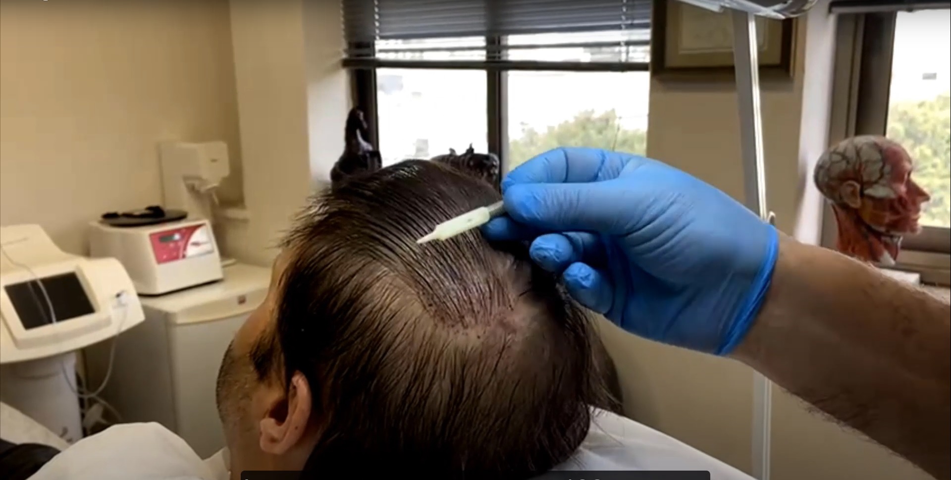 יאיר גילוני "האם השתלת שיער סינתטי תלויה בעונות השנה?"