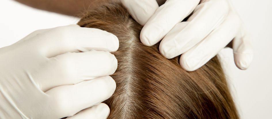 שמירה על היגיינת הקרקפת לאחר השתלת שיער סינתטי
