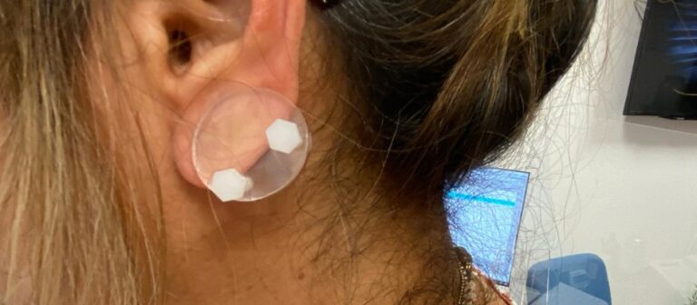 עגילי לחץ לשיפור הטיפול בקלואיד באוזן