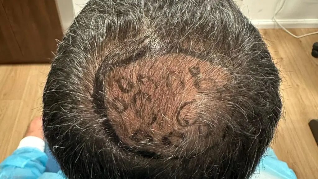 השתלת שיער FUE - סימון אזור ההשתלה