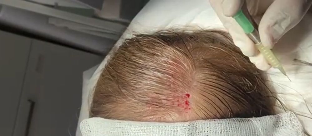 השתלת שיער סינטטי לנשים