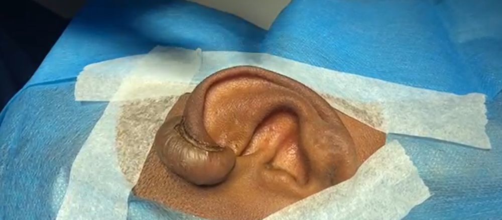 קלואיד באוזן המכסה את פרופיל האוזן