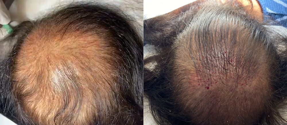 לפני ואחרי השתלת שיער סינטטי - 500 שערות בלבד