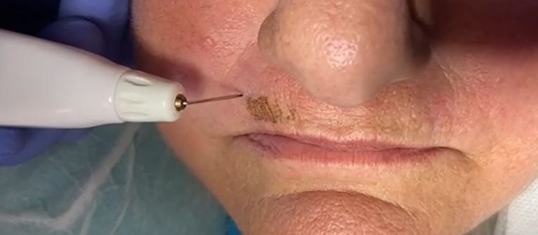 טיפול בקמטי עישון מעל השפה