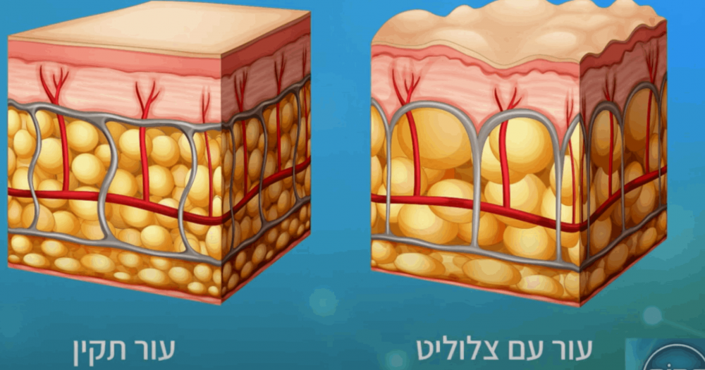טיפול בצלוליט טיפול בצלוליט