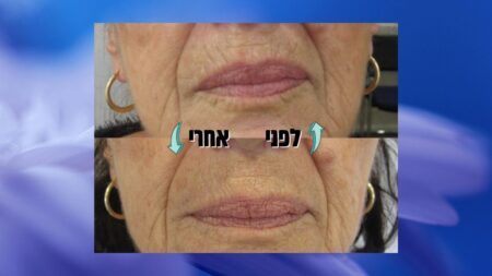 קמטי עישון (ברקוד) - לפני ואחרי